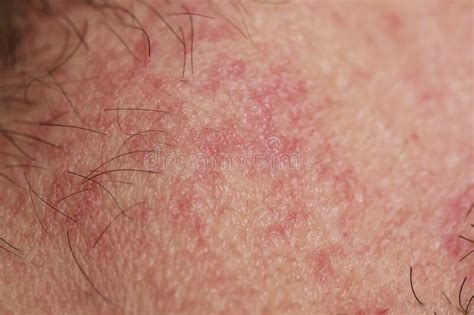 Irritated Reddened Skin With Flaking Scales Of Dead Old Cells After