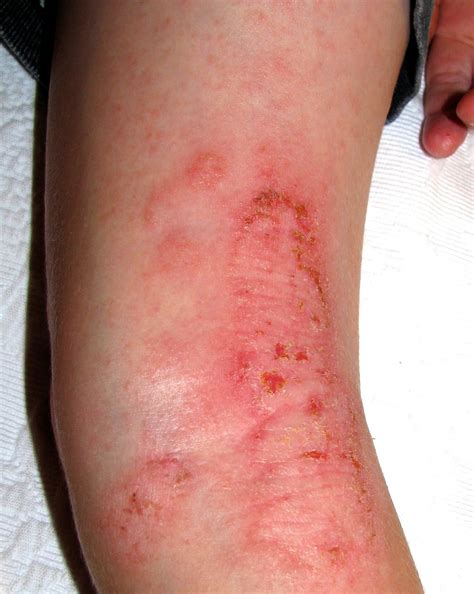 Eczema Behind Knee 7 Year Old With Eczema Flare And Staph Care