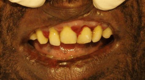 Gingival Swelling And Bleeding In Our Patient With Scurvy Download
