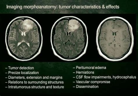Pin By Majeja84 On Radiologija Radiology Blogging Quotes Brain Tumor