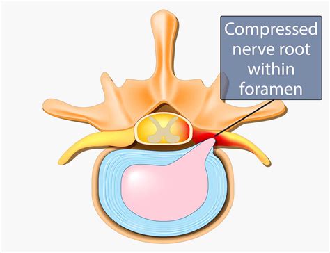Spinal Stenosis Symptoms Diagnosis Treatment Miami Neuroscience Center