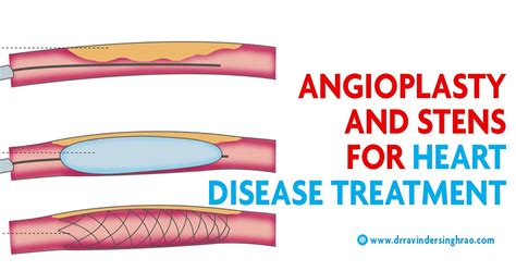 Coronary Angioplasty And Stents Angioplasty And Stent Placement Dr