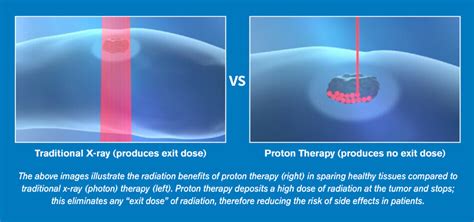 Benefits Of Mclaren Proton Therapy