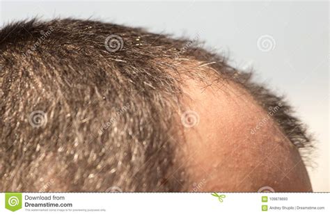 Bald Spots On The Head Of A Man Stock Image Image Of Receding Style