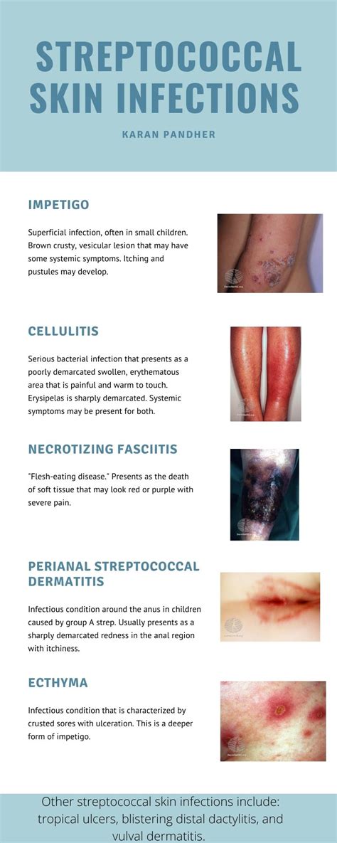 Quick Review On Streptococcal Skin Infections Images Grepmed