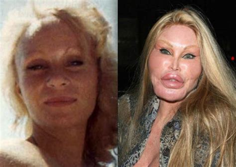 Catwoman Plastic Surgery Before And After Picture Cat