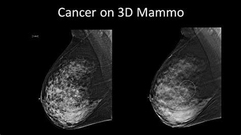 The kaggle breast histopathology images dataset was curated by janowczyk and madabhushi and roa et al. 3D Mammography Increases Odds Of Detecting Breast Cancer ...