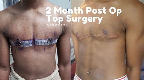 Month Post Op Top Surgery Ftm Youtube