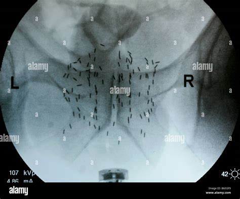 Yodo Radiactivo Fotografías E Imágenes De Alta Resolución Alamy