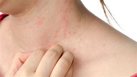 What Are The Signs Of A Severe Allergic Reaction Icare