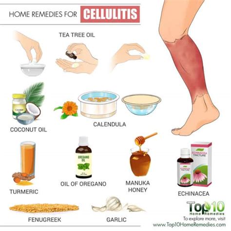 Home Remedies For Cellulitis Silicon Valley Natural Health