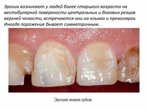 Эрозия зубов - презентация онлайн Картинка - Эрозия зубов - презентация онлайн