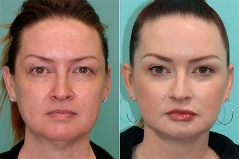 Blepharoplasty Photos Chevy Chase Md Patient 19942