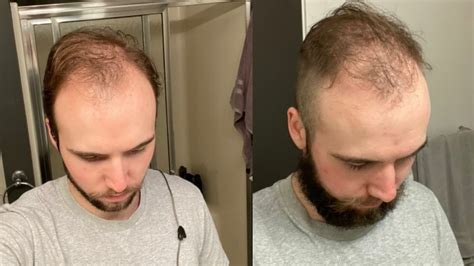 Balding At 20 Why Im Shaving My Head Bald Youtube