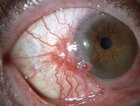 Case Of Conjunctival Squamous Cell Carcinoma Reported In Nejm