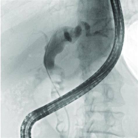 Initial Cholangiogram Showing Multiple Common Biliary Duct Calculi