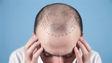 Hair Transplant The New Male Must Have Procedure Medical Travel Market