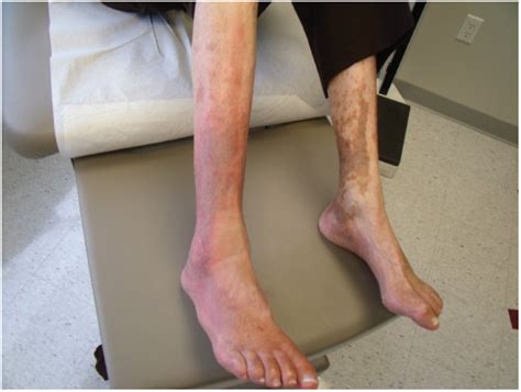 An Elderly Man With Leg Pain And Chronic Rash Consultant360