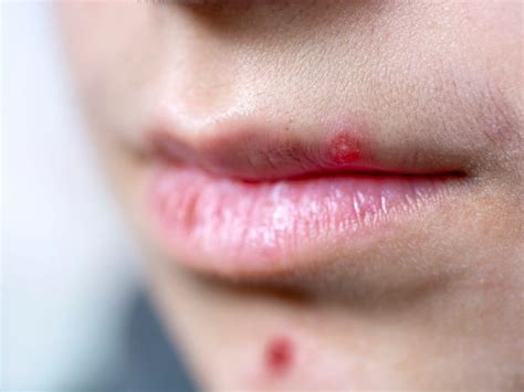 Bumps On Lips Causes Treatments And More