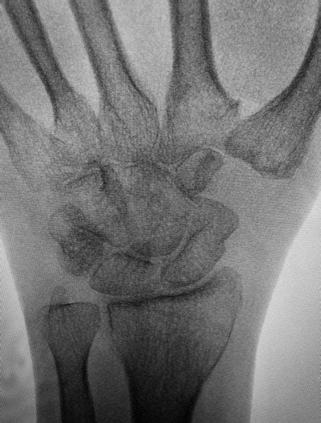 Thumb Cmc Joint Replacement University Orthopedics