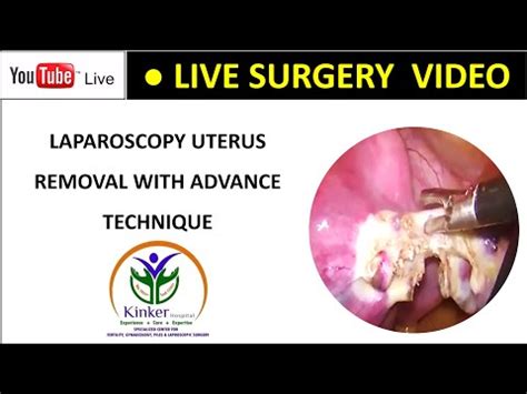 Laparoscopy Uterus Removal With Advance Technique Youtube