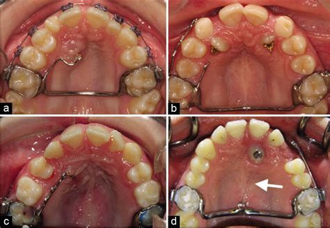 Orthodontic Management Of Impacted Maxillary Canines Apos Trends In