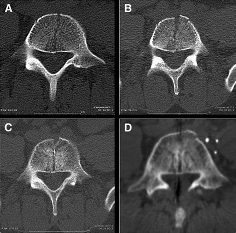 Fig 5 Prevention Of Vertebral Bodysplitting Fractures After Multilevel Prodisc L