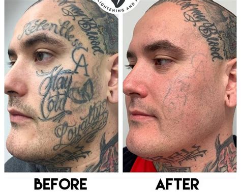 Best Overview Helpful For Tattoo Removal Before And After An Overview