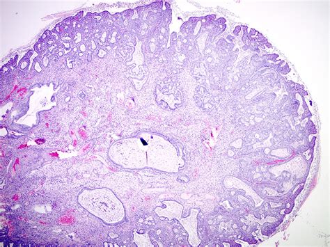 Pathology Outlines Endocervical Polyp