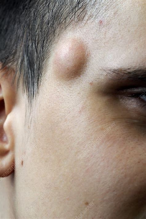 Sebaceous Cyst On The Face Stock Image C Science Photo Library
