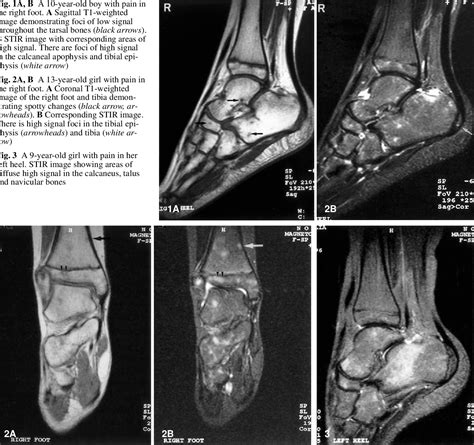 Learn more details about them at kenhub! Heterogeneous signal in bone marrow on MRI of children's feet: a normal finding? | Semantic Scholar