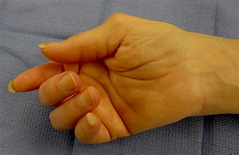 The fpl is the only tendon which is able to flex the interphalangeal joint of the thumb. RHEUMATOID ARTHRITIS | Hand Surgery Source