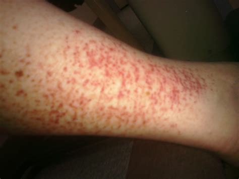 Spots may appear to be flat, meaning they are under the skin. Petechiae - Symphtoms of hemorhagic spots | HubPages