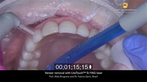 Veneer Removal With Litetouch™ Eryag Laser Youtube