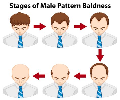 7 Effective Treatments For Male Hair Loss In Singapore Singapore Beauty