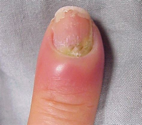 Hangnail Infection Good Health