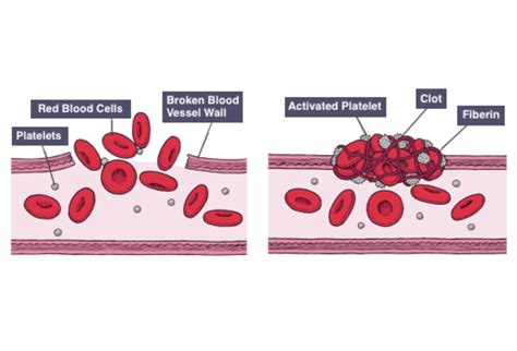 Igcse Biology Notes Understand That Platelets Are Involved In Blood Clotting Which