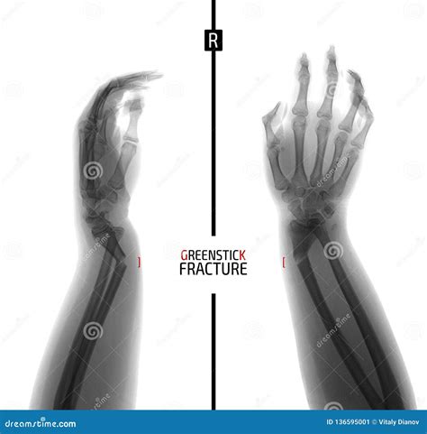 X Ray Of The Wrist Greenstick Fracture Of The Radius Marker Negative