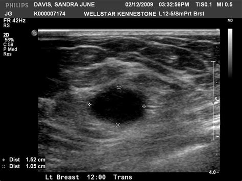 Breast Cancer Images Ultrasound