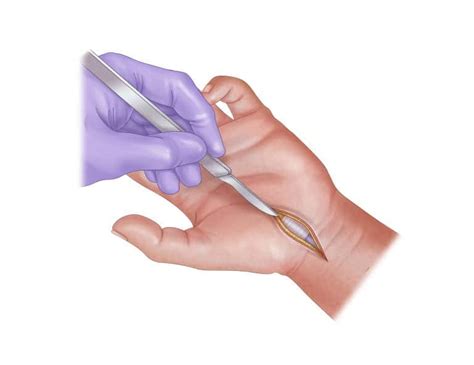 Check spelling or type a new query. How long does it take to heal from carpal tunnel release ...