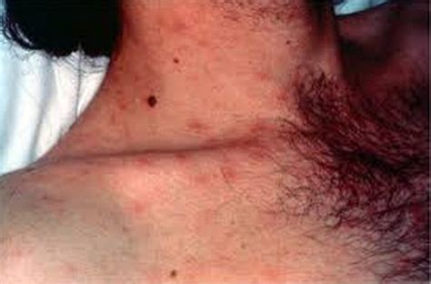 Hiv Rash Pictures What Does Hiv Rash Look Like How Is It