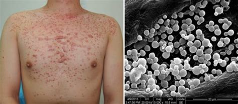 What Is Difference Between Keratosis Pilaris And Folliculitis Compare