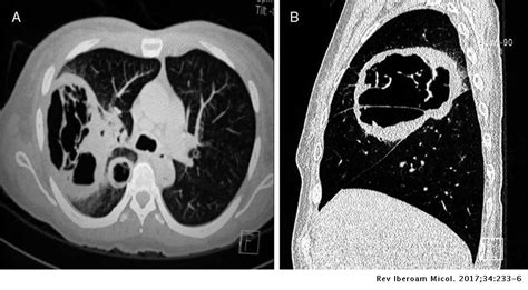 La mucormicosis (anteriormente conocida como cigomicosis) es una enfermedad rara, no se trata de una enfermedad contagiosa, los mucorales se encuentran en el ambiente y pueden entrar por vías respiratorias (también digestiva o a través de heridas en la piel). Mucormicosis pulmonar en un paciente con trasplante renal ...