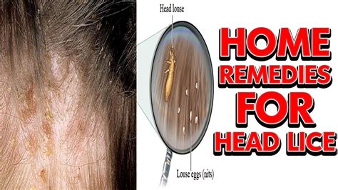 How To Get Rid Of Lice Fast Home Remedies For Head Lice Youtube