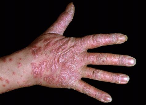 Second Trial Confirms Efficacy Of Bimekizumab In Plaque Psoriasis