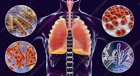 Bacteria That Cause Lung Infections Illustration Stock Image F023
