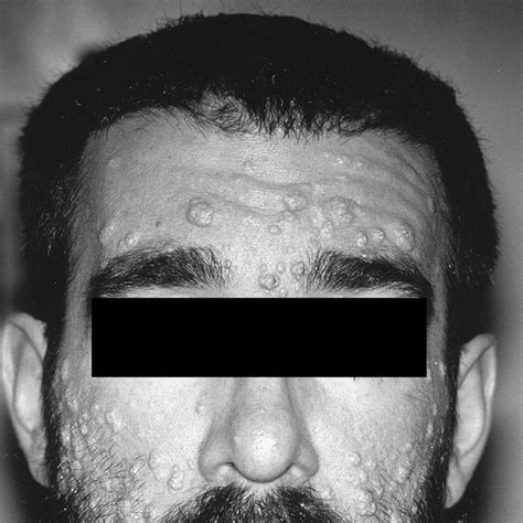 Numerous Scattered Facial Lesions Of Molluscum Contagiosum In A Patient