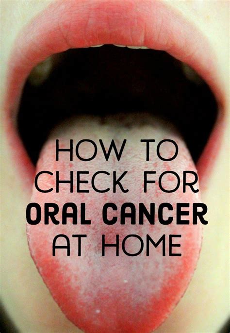 Oral Cancer Sores On Tongue
