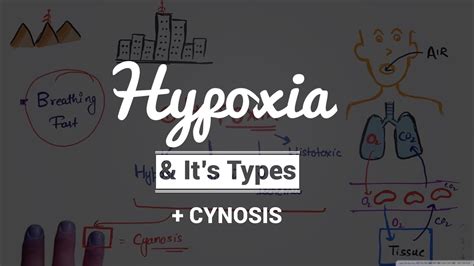 Hypoxia And Cyanosis Causes And Pathogenesistypes Of Hypoxia Hypoxic