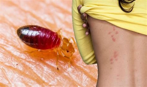 Bed Bug Bites Spots Arranged In Zigzag Lines Clusters Or Rows Is A